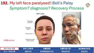 192. My left face paralysed! Symptom? diagnosis? Recovery Process? 我左邊面癱了!(中英Subtitle）