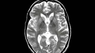 Neoplastic Disease Metastatic adenocarcinoma