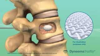 Cement Vertebroplasty - Medical Animation by Watermark