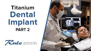 Placing a Crown on a Prepared Titanium Dental Implant — PART 2