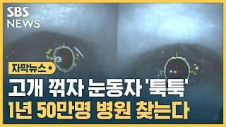 1년에만 50만 명 앓는 이 병, 희소식이 들려왔다 (자막뉴스) / SBS