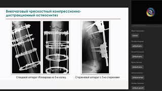 Физиология и патология заживления переломов костей конечностей