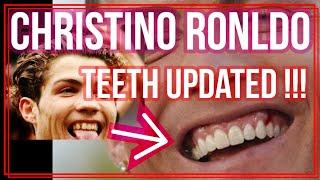 Christiano Ronaldo teeth newly updated!! before and after  then & now cosmetic transformation