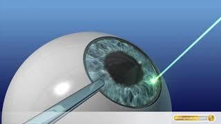 Augen-OP mit Laser: So funktioniert LASIK