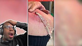 REACTING To Popping HUGE Blackheads and Pimple Popping | Best Pimple Popping Videos 83