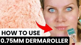 HOW TO GET RID OF DEEP ACNE SCARS, WRINKLES, AND HYPERPIGMENTATION WITH 0.75MM DERMAROLLER (2025)