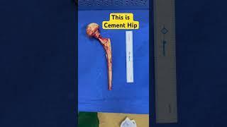 Cement hip spacer used for infections of hip replacement