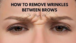 How To Get Rid Of Wrinkles Between Eyebrows  Dr Nina Bal, Glabellar Lines Removal