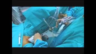 THULEP thulium laser prostate enucleation, Operation Theare. Dr. Farid Gadimaliyev