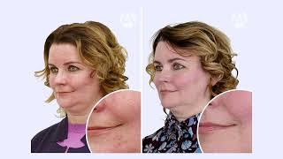 Розацеа  Фотолечение, как эффективный метод лечения заболевания