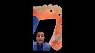 Learning From Our Leaders: Dr. Rawal - Overdentures