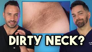 Dark Neck, Armpits, Groin? How to Treat and Prevent Acanthosis Nigricans