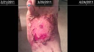 2nd Degree burns on foot - healing time lapse - 2 months