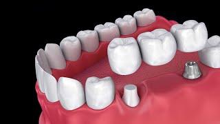 Combined dental crown and implant.