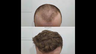 1993 Grafts FUE Hair Transplant Result- The Treatment Rooms London- Hair Transplant Clinic