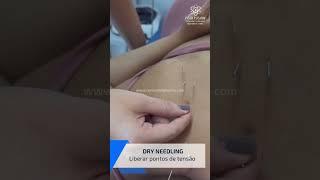 AGULHAMENTO SECO #saude #reabilitação #sports #shorts #reels #fisioterapia #futebol #joelho #pe