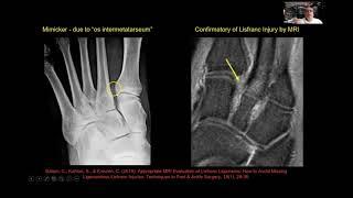 Dr. Jeimylo de Castro talks about MSK Ultrasound of the Forefoot