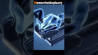 3D Animation of Hemorrhoidoplasty Procedure. #shorts