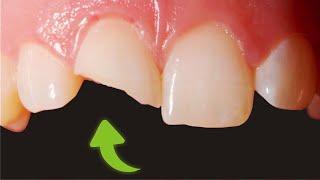 RECONSTRUCTION of front tooth - fractured tooth