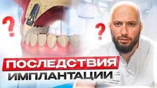 Самые распространенные ЖАЛОБЫ после ИМПЛАНТАЦИИ зубов