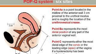 Pelvic Organ Prolapse