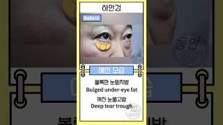 중년 여성의 하안검 회복기간 비교경과 #하안검수술전후 #shorts