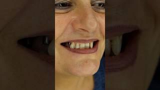Head-Turning Smile Transformation with Dental Implants and Zirconia Crowns 