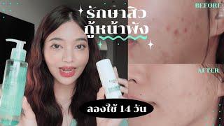 รีวิวสกินแคร์รักษาสิวกู้หน้าพัง ลองใช้ 14 วัน จัดการปัญหาสิวอุดตันได้ถึงต้นตอ (Eucerin) | mildnitha