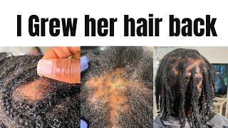 How I healed her Alopecia Growing back her hair