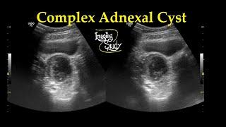 Complex Adnexal Cyst || Ultrasound || Case 27