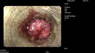 Bleeding Grade III Internal Haemorrhoids seen on Video Proctoscopy