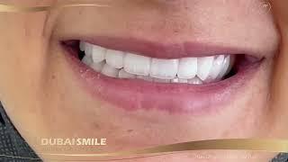 Hollywood Smile price in UAE