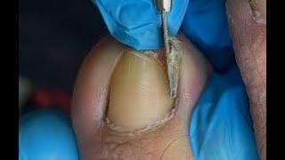 Huge ingrown toenail removal