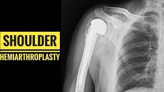 Shoulder Hemiarthroplasty (Detailed Surgical Technique)