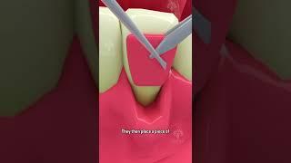 Fixing Receding Gums #shorts  #dentalcare - Creativelearning3d