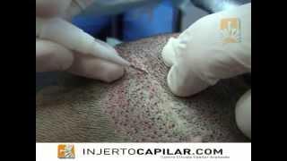 1901 FU´s. Reparación de cicatriz con Lion Implanter. Scar repair. Injertocapilar.com. 1302/2015