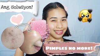 BAKIT HINDI NA AKO NAGKA PIMPLES?! ITO ANG RASON! ANGELICA DELAR | PHILIPPINES