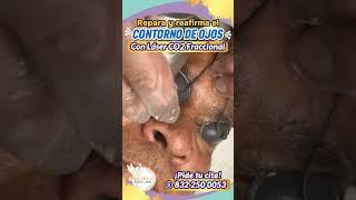 Embellece tu mirada con Nanofraccional en Paloma Clínic Spa #radiofrecuencia #radiofrecuenciafacial