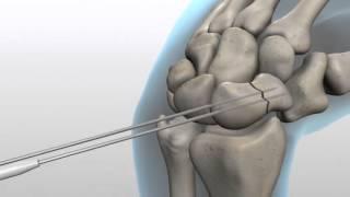Trauma Solutions - Acumed Surgical Technique