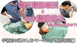 【受付スタッフの整形密着】顎下脂肪吸引とCRF脂肪注入(額•こめかみ•目の下)【術前•マーキング•脂肪吸引編】