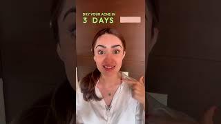 Dry Acne in 3 days I 3-step skincare routine acne and breakouts I FaceYogaByVibhutiArora #acne