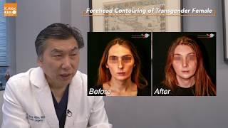 Forehead Contouring of Transgender Female by Dr. Alex Kim M.D