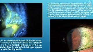 Meibomian Gland Dysfunction: Where Dry Eye Begins - Dr. Craig Thomas