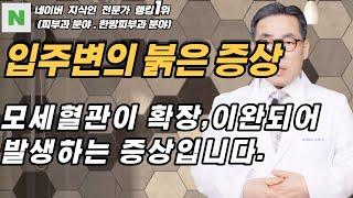 4K)입술 주변에 발생하는 붉은 증상은,모세혈관이 이완되어 나타나는 증상입니다.