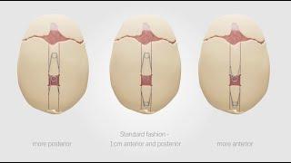 CranioXpand | Expanding Possibilities