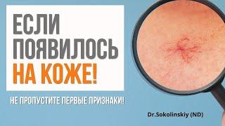 ВЫСЫПАНИЯ НА КОЖЕ: не пропустите эти симптомы, они указывают на зреющие внутри проблемы!