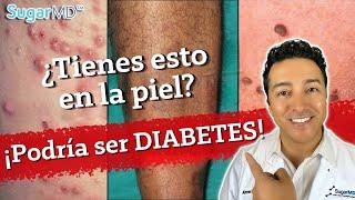 12 problemas de la piel en diabéticos y principales signos de diabetes en la piel  | SugarMDS.com