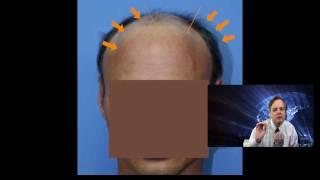 Hair Transplant Play-By-Play #2 -Hair Regrowth ! Feller and Bloxham, NY | New Jersey | Connecticut