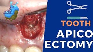 Apicoectomy surgery - Live procedure step by step