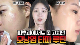 (요청폭주)5년을 고생하던 모낭염 박살낸 나만의 루틴 공개